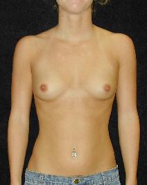 1_breast_before